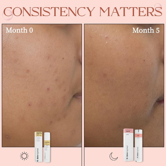 SkinInspired Aha+Bha+Pha Lactic Acid + Salicylic Acid Face Serum|Exfoliating Serum For All Skin Types|Pore Cleansing Face Serum|Reduces Acne&Blackheads|Peeling Solution For Glowing Skin|50 Ml