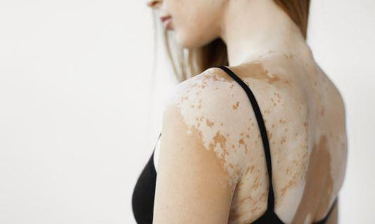 Vitiligo ( Safed Daag ) - Causes, Possible Treatments and Prevention. - GLEIN PHARMA